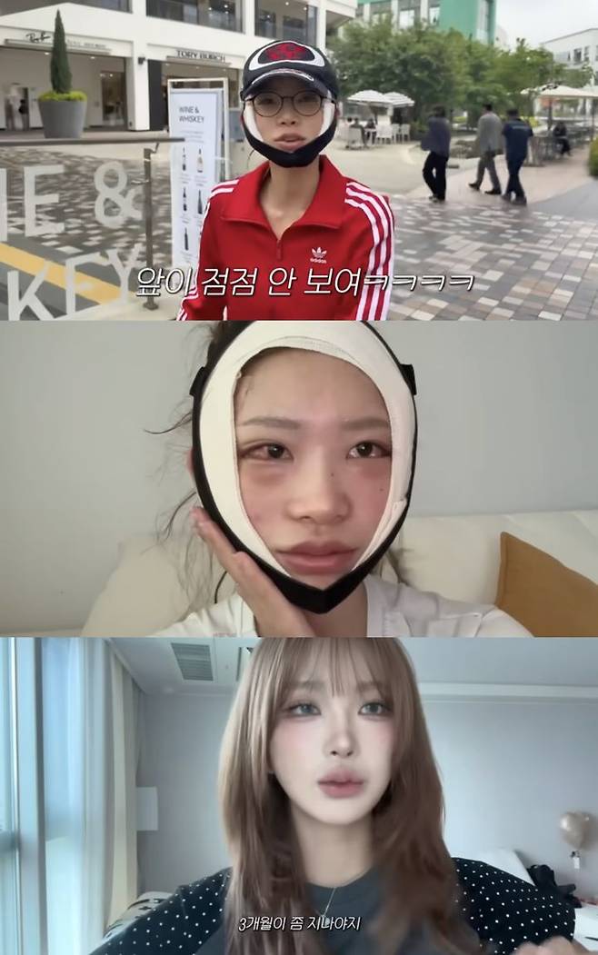 [서울=뉴시스] 최준희가 지난 8일 유튜브 채널 '준희'에  안면 윤곽, 눈 밑 뒷트임 성형수술 후기를 밝혔다. (사진=유튜브 채널 '준희' 캡처) 2025.07.11. photo@newsis.com  *재판매 및 DB 금지