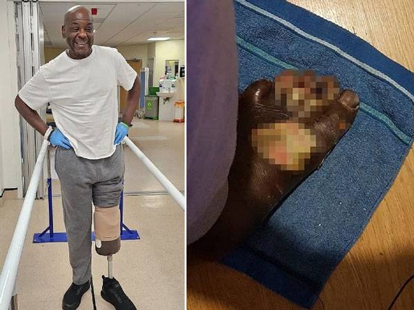 작은 화상이 생명을 위협하는 패혈증으로 이어져 결국 다리를 절단한 한 남성의 사연이 전해졌다. 다리 절단 후 남성의 모습(왼쪽)과 다리 절단 전 괴사되고 있던 발 사진./사진=데일리메일