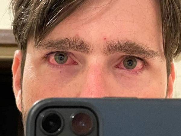 네이선 클로우(35)는 시력을 좋게 하려 라식 수술을 받았는데 오히려 눈이 충혈되고 극심한 건조증에 시달리게 됐다./사진=더 선