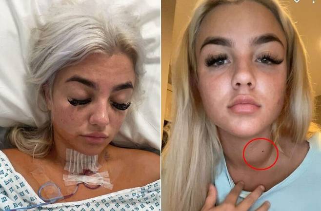 사연 속 여성이 진단받은 수질암은 갑상선암 중에서도 0.5~1%를 차지할 정도로 희귀한 암이다. [사진=SNS]