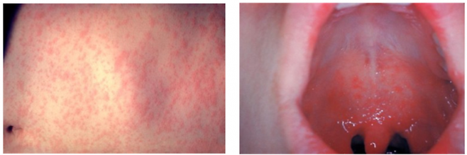 홍역 발진(왼쪽) 및 홍역으로 인한 구강 내 Koplik 반점. 미국질병관리본부