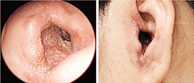 급성 외이도염 귀 증상.