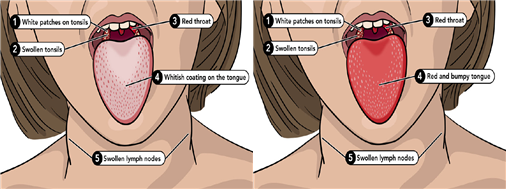 성홍열은 인후통에 동반되는 갑작스런 발열, 두통, 식욕부진, 구토, 인두염, 복통이 주요 증상이다. 초기에는 혀에 회백색으로 덮인 돌기가 두드러지다가(그림 왼쪽) 2~3일이 지나면 붉은 색을 띄고 돌기가 붓는 딸기 모양의 새빨간 혀가 된다(그림 오른쪽). /제공=제주도. ⓒ제주의소리