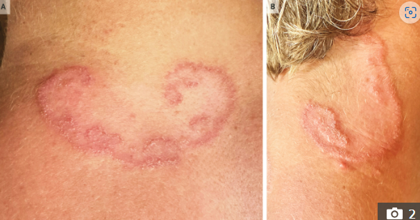 미국 캘리포니아에 사는 10대 소년이 해변 모래에 누워 있다가 기생충 감염으로 목에 뱀 모양의 발진이 발견됐다. [더선 캡처]