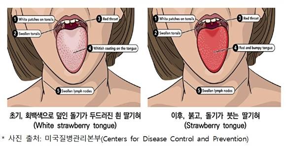 성홍열 증상. [사진=청주시]