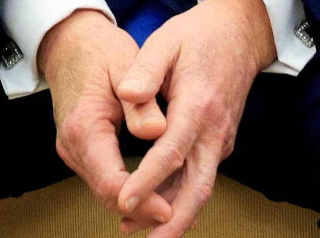 지난 2월 에마뉘엘 마크롱 프랑스 대통령과 정상회담을 한 도널드 트럼프 미국 대통령의 오른손에 포착된 큰 멍 자국./로이터 연합뉴스