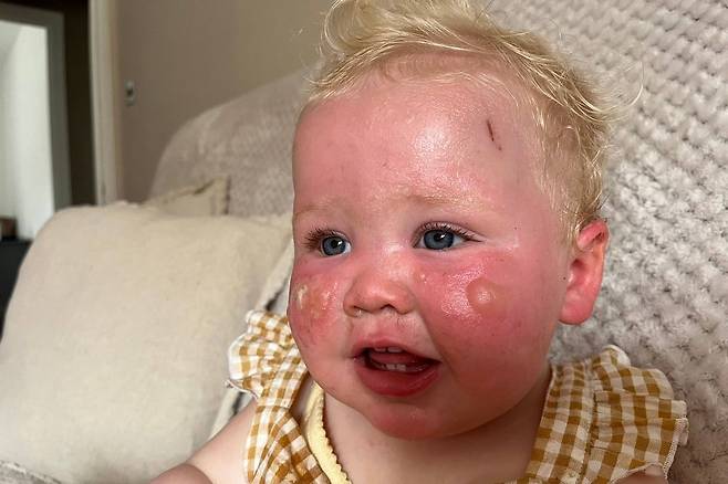 병원에서 2도 화상 판정을 받은 딸 레건. 로렌 인스타그램 캡처