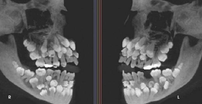 브라질의 한 11세 소녀 입 안에서 치아가 무려 81개나 발견돼 의료진과 학계에 충격을 주고 있다. 출처=VN익스프레스