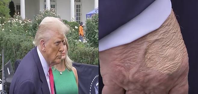 도널드 트럼프 미국 대통령의 손등에 멍을 가린듯한 화장 자국이 포착되며 건강 이상설이 다시 불거지고 있다. 데일리메일 웹사이듵 갈무리 뉴시스