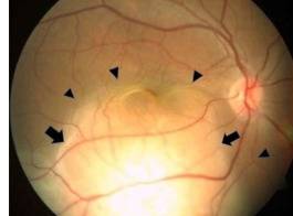 온몸에 전이된 페암의 첫 증상으로 실명한 30대 여자 환자의 오른쪽 안구. 검은 화살표 부위에서 눈으로 전이된 암이 발견됐다. [Radiology Case Reports 캡쳐]