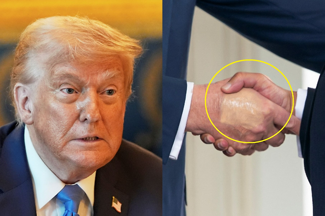 (왼쪽) 도널드 트럼프 미국 대통령이 지난 7일(현지시각) 워싱턴 백악관에서 베냐민 네타냐후 이스라엘 총리와 회담을 하고 있다. AP 연합뉴스 (오른쪽) 지난 16일 트럼프 대통령이 백악관에서 바레인 왕세자와 악수를 하고 있다. 오른손에 화장을 한 모습이 보인다. 로이터 연합뉴스