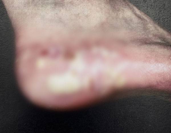 손발바닥농포증이 나타난 발 사진./사진=UpToDate