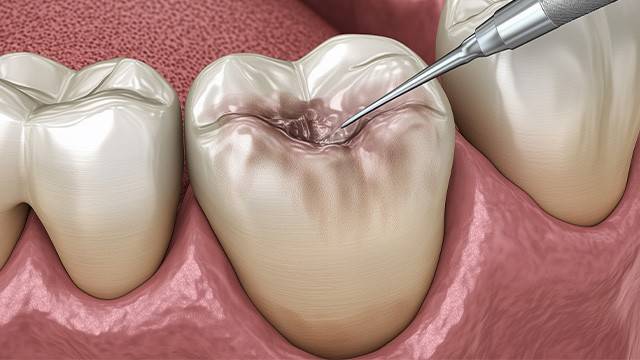충치의 경우 치료보단 정기검진을 통해 지켜보는 것이 유리한 경우도 있다｜출처: 게티이미지뱅크