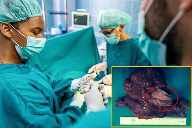 출산 후 수년 간 원인 모를 통증에 시달리던 30대 여성의 몸속에서 수술용 스펀지가 발견된 사례가 보고됐다. [배경사진=게티이미지뱅크/우측 하단 사진='Case Reports in Surgery']