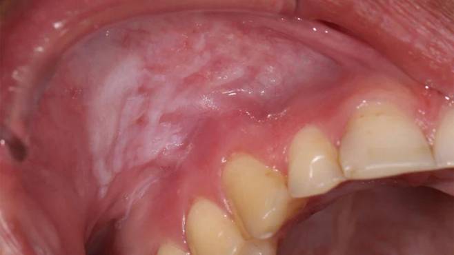 반복적인 니코틴 파우치 사용으로 인해 생긴 흰색 병변