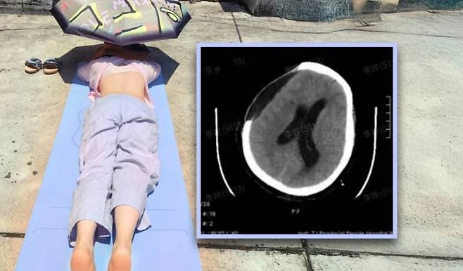 20일(현지시간) 홍콩 사우스차이나모닝포스트(SCMP)에 따르면 중국 저장성에 사는 왕모씨(67·여)는 최근 야외에서 일광욕을 즐기다 쓰러져 병원으로 이송됐다. 2025.7.20 SCMP 캡처