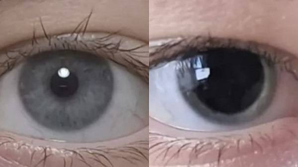 영국의 한 여성이 동공이 비정상적으로 커져 있는 모습을 SNS에 올린 후 응급상황임을 알게 된 사연이 공개됐다. 왼쪽은 증상 발현 전, 오른쪽은 증상 발현 후 모습./사진=온라인 커뮤니티