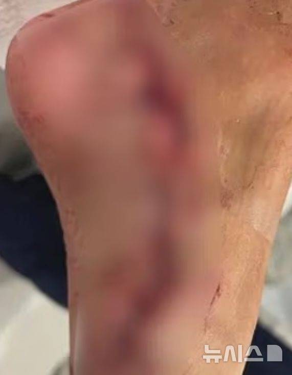 [서울=뉴시스] 미국 플로리다 주 뉴 스머나 비치 해안에서 서핑을 하던 중 18세 서핑 강사 샘 홀리스가 상어에게 발을 물린 사고가 발생했다. 사진은 상어에 물린 샘 홀리스의 상처. (사진=데일리메일). 2025.07.21.