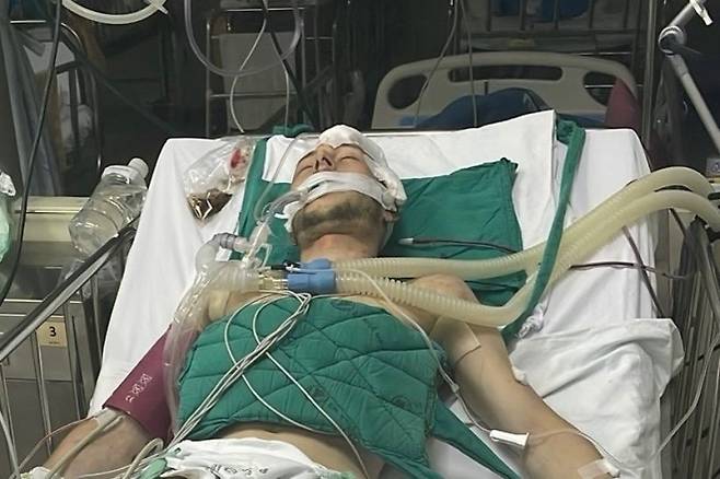 태국에 놀러갔다가 아직 밝혀지지 않은 이유로 혼수상태에 빠져 방콕 인근 촌부리주의 한 병원에서 뇌 수술을 받은 29세 영국인 애쉬튼 존스가 생명유지장치에 의지한 채 태국 병원에 누워 있는 모습. 애쉬튼은 가족의 모금을 통해 수천만원에 이르는 병원비를 지불한 뒤 최근 영국으로 귀국했다. 온라인 모금 사이트 고펀드미 캡처