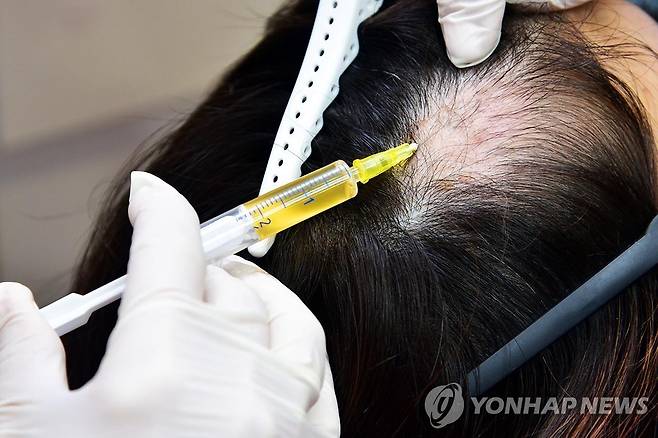 탈모 치료 [서울대병원 제공]