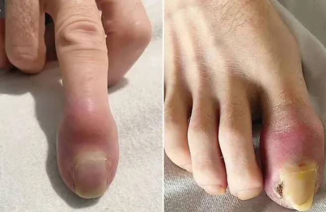 손가락과 발가락이 붓는 증상이 단순한 염증이나 외상이 아니라, 전이암의 신호일 수 있다는 사례가 보고됐다. [사진=New England Journal of Medicine]