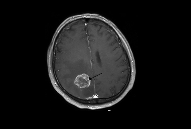 뇌종양 관련 이미지. 기사와 직접적인 관련 없음. 위키피디아