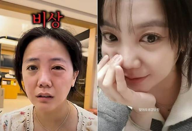 고은아처럼 눈이나 입 주변, 얼굴 등이 부으면 기도 부종으로 발전해 아나필락시스로 이어질 가능성이 크다. 이럴 때는 즉시 응급실을 찾아 에피네프린 주사 등 적절한 치료를 받아야 한다. [사진=SNS]