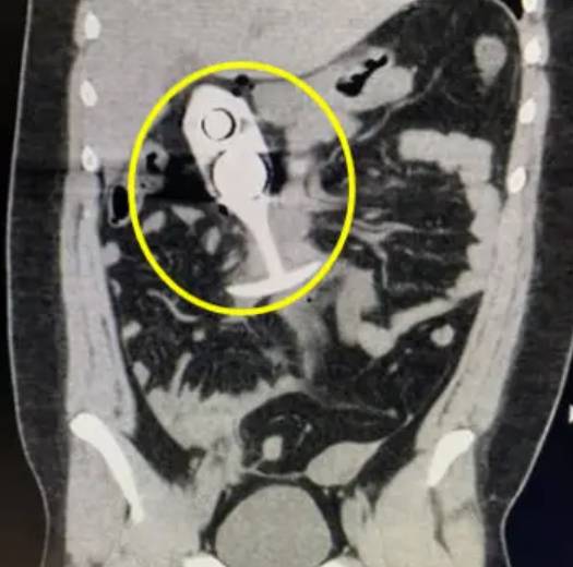 MRI(자기공명영상) 촬영 중 20대 여성이 몸 속에 삽입한 성인용품이 강력한 자기장에 반응해 심각한 사고로 이어졌다. 사진은 해당 MRI 사진. [사진=X 갈무리 ]