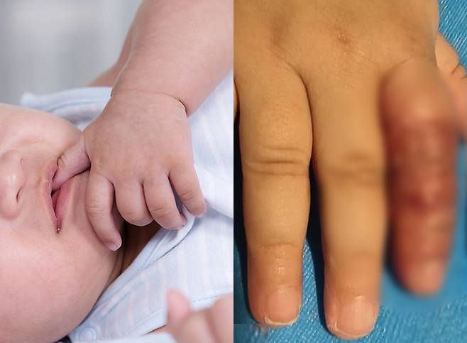 손가락을 빠는 아기의 모습(사진 왼쪽·기사 이해를 돕기 위한 자료 사진), 손가락 빠는 습관을 고치기 위해 손가락에 붕대를 감았다가 피부가 괴사된 중국 아이의 손가락.(사진 오른쪽) /사진=이미지투데이, 홍콩 사우스차이나모닝포스트