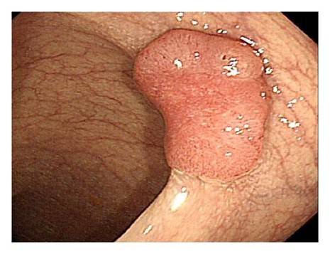 대장암 [대한대장항문학회 제공]