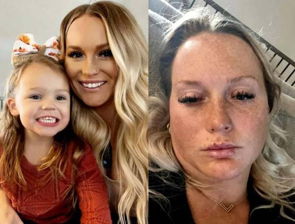 주름 개선을 위해 맞은 보톡스 유사 주사제 때문에 심각한 부작용을 겪은 아만다 울라버. 부작용 겪기 전(왼)과 겪은 후(오)다./사진=뉴욕포스트