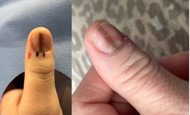 한 여성이 손톱의 미세한 변화에서 시작된 의심으로 피부암 진단을 받은 사실을 공유했다.  [사진=로렌 콜츠 SNS]