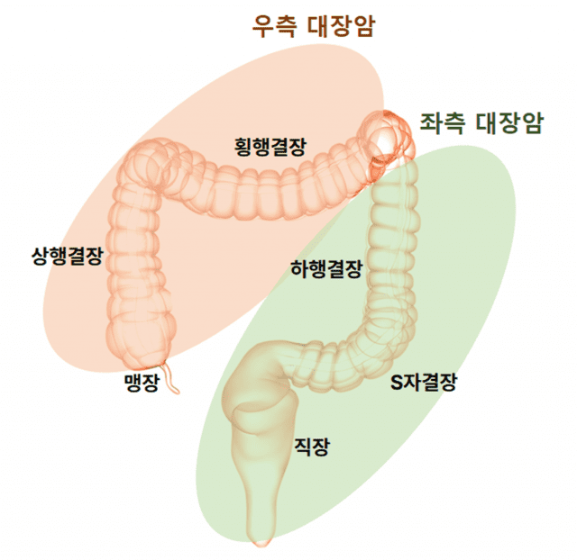 정면에서 바라본 대장암의 위치별 분류(그림=분당서울대병원)