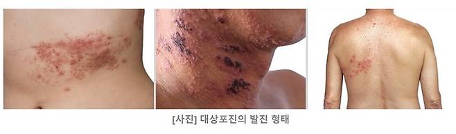 대상포진의 발진 형태 (사진=GSK '싱그릭스' 프레스킷) *재판매 및 DB 금지