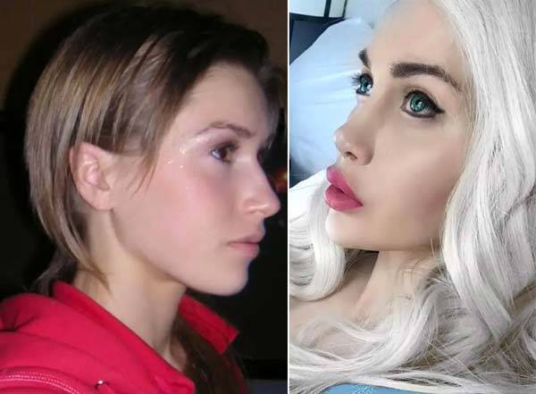 디즈니 공주 캐릭터와 같은 이미지를 추구해 무려 열다섯 번의 성형수술을 받았지만, 극심한 부작용을 겪으면서 성형 중단을 선언한​ 픽시 폭스. 성형 전(왼)과 성형 후(오) 사진 /사진=더 선