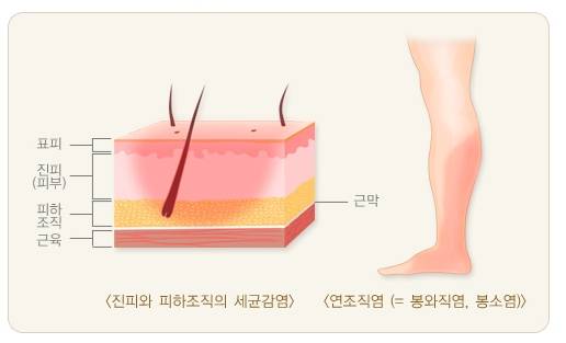 봉와직염의 침범 부위 모식도. /그림=질병관리청 국가건강정보포털