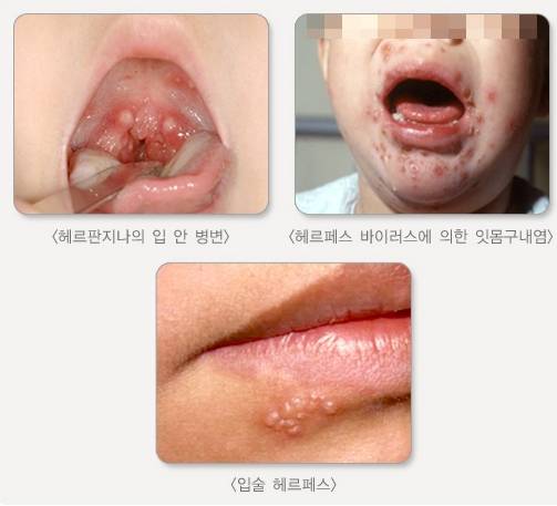 수족구병과 구별해야 하는 질환들. /사진=질병관리청 국가건강정보포털