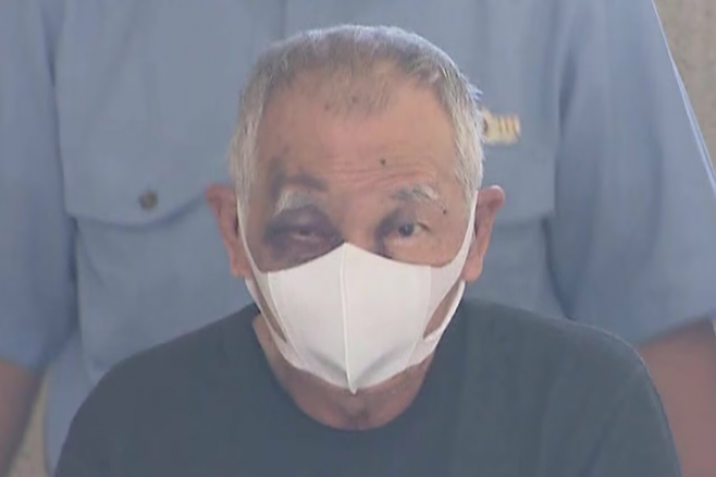 일본 지바현경 후나바시히가시서는 살인미수 혐의로 지바현 후나바시시에 거주하는 후루타니 다카노부(76)를 지난 3일 체포했다. 사진은 후루타니 얼굴에 아들에게 폭행당해 생긴 것으로 추정되는 멍이 남아있는 모습. 후지TV 보도화면 캡처