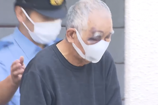 일본 지바현경 후나바시히가시서는 살인미수 혐의로 지바현 후나바시시에 거주하는 후루타니 다카노부(76)를 지난 3일 체포했다. 사진은 후루타니 얼굴에 아들에게 폭행당해 생긴 것으로 추정되는 멍이 남아있는 모습. 후지TV 보도화면 캡처