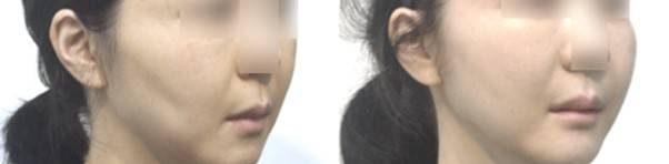 광대 수술 후 발생한 볼 처짐으로 안면거상을 받았지만, 효과가 만족스럽지 않았던 환자로, 골막하 거상' 후에는 눈에 띄게 개선된 모습을 확인할 수 있다.