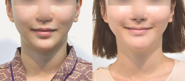 골막하 거상후 웃는 표정이 함께 개선된 모습.