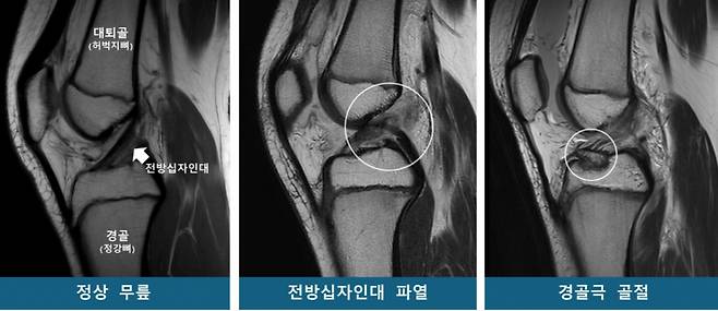 정상 무릎과 무릎 부상 환자의 MRI(자기공명영상) 촬영물. /사진=서울대병원