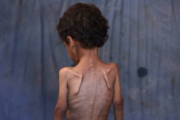 굶주려 영양실조에 걸린 가자지구 난민캠프의 2세 아기.(사진=AFP)