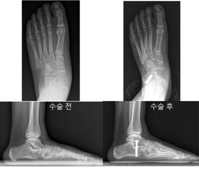 ‘종골 정지술’을 받은 12세 환아의 수술 전(좌)과 수술 3년 후(우) 방사선 및 발 사진. 수술 후 발의 정렬이 정상에 가깝게 교정됐으며, 아치 또한 회복되어 평발 변형이 효과적으로 교정된 모습을 확인할 수 있다.
