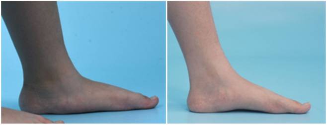 ‘종골 정지술’을 받은 환아의 수술 전(좌)과 수술 3년 후(우) 발 사진