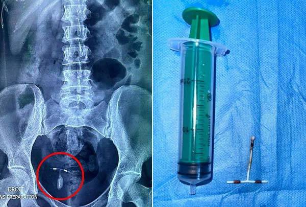 여성의 방광으로 옮겨간 후 석회화된 자궁 내 장치를 보여주는 복부 엑스레이(왼)과 제거된 자궁 내 장치(오) /사진=데일리메일