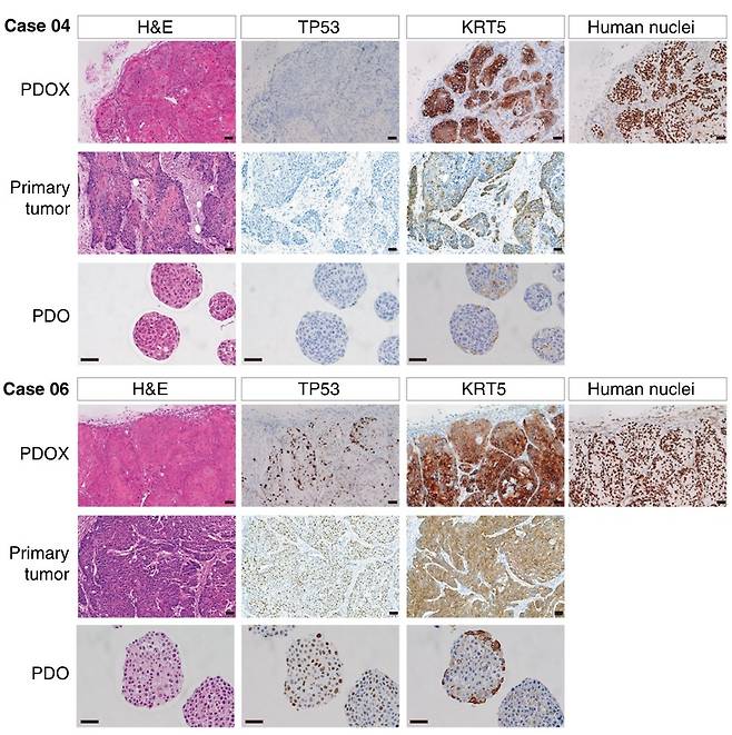 [그림2] 연구팀이 다양한 유전자 돌연변이를 동반한 두경부암 오가노이드 배양에 성공했음을 보여주는 두경부암 오가노이드 라이브러리.