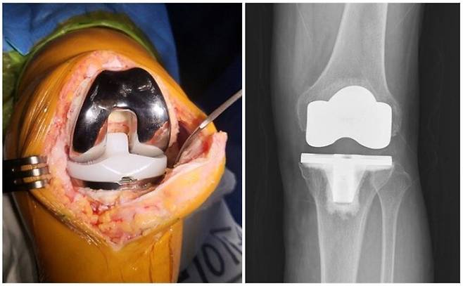 '전치환술' 술 중 사진 & 술 후 X-ray.