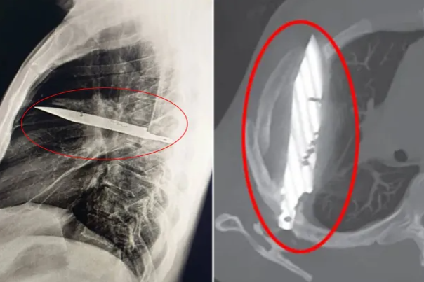 8년간 가슴 통증에 시달려온 남성의 흉부 엑스레이 사진. 흉부 중앙에거대한 칼이 꽂혀 있는 모습이 보인다. [더선 캡처]