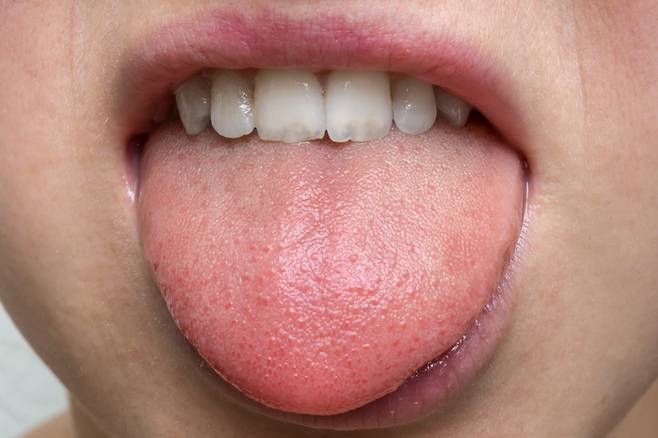 혓바닥은 건강 상태를 파악하는 데 중요한 부위다. 항응고제를 써야 하는 심혈관병 환자 등은 혓바닥 밑에 피 멍울이 생기는 '설하혈종'에 걸릴 수 있으니 관심을 갖는 게 좋다.[사진=게티이미지뱅크]